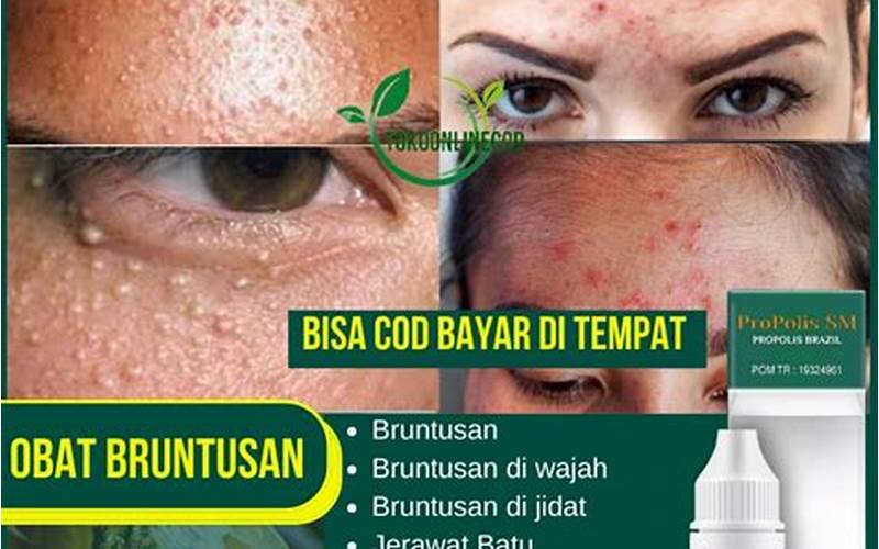  Penghilang Jerawat Dan Bruntusan: Sebuah Solusi Untuk Kesempurnaan Wajah 