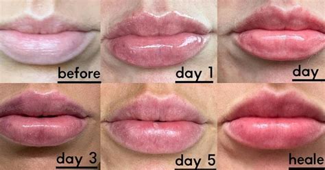 factors affecting lip injections duration