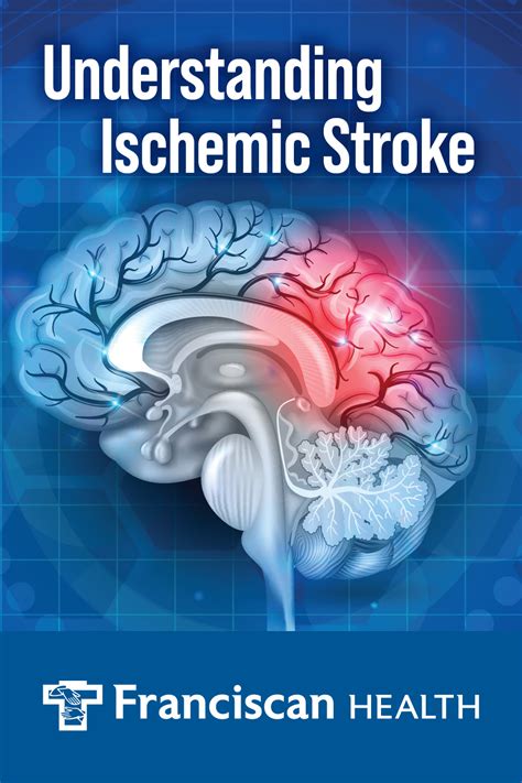 Understanding Ischemic Strokes