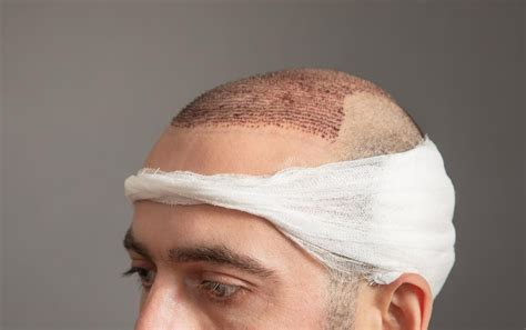 [How-To] How To Safely Remove Post-Surgical Scabs Without Pulling Out Follicles