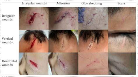 [Patient Safety] Preventing Scalp Trauma By Customizing Channel Incision Depths