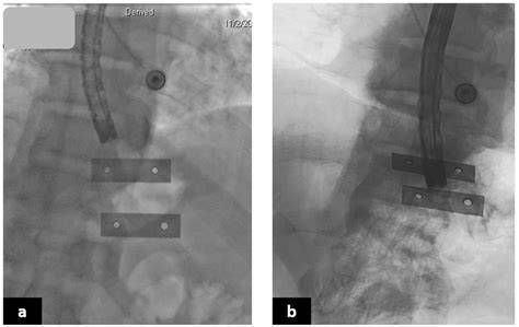 [Tech Breakdown] Fluoroscopic Guidance Integration During Complex Endoscopic Suturing Cases
