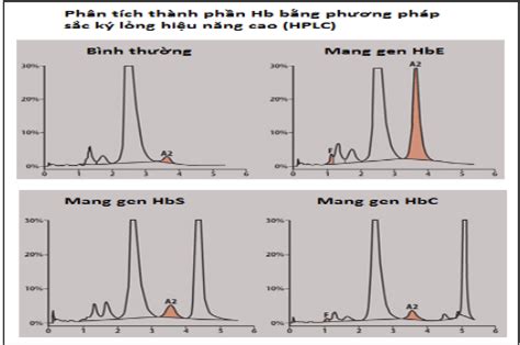 đọc kết quả điện di hb