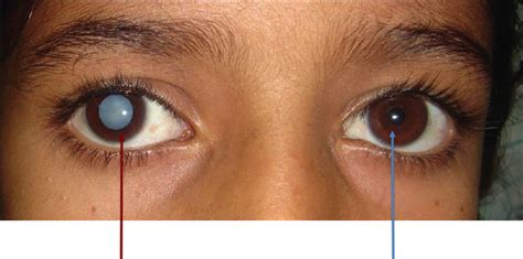 đục thuỷ tinh thể mắt là gì