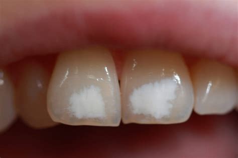 белые пятна на зубах