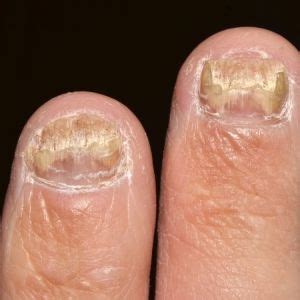 болест на ноктите мкб