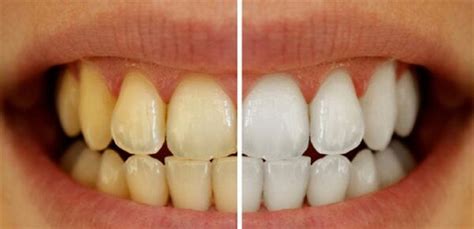 خطوات سهلة لعلاج اصفرار الأسنان في 4 خطوات فقط