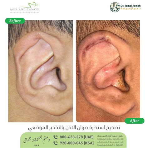 إعادة تشكيل الأذن في الرياض