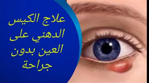 علاج الكيس الدهني في العين