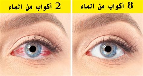علاج جفاف العين في المنزل
