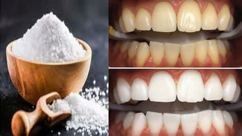 طرق مختلفة لتبييض الأسنان الخاصة بك