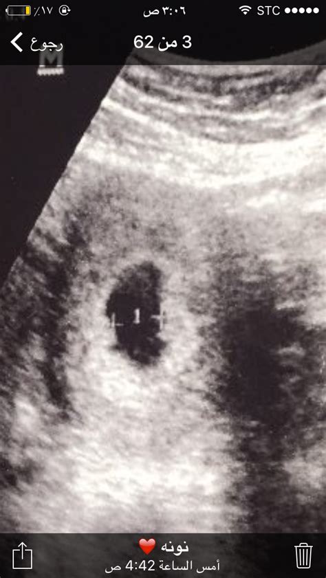 شرح الخطوات التي تشرح كيفية تشكيل كيس الحمل عند النزول