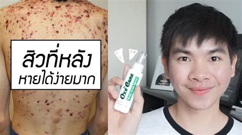 Acne Clear Therapy (โปรเเกรมรักษาสิว) DS SKIN CLINIC คลินิกผิวหนัง