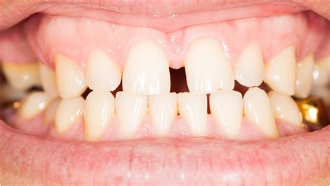 すきっ歯自力改善法！簡単に治すテクニックをご紹介！
