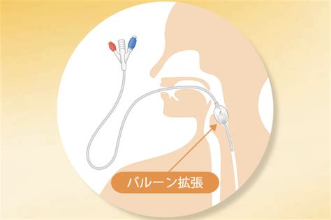 Cook ® 子宮頸管拡張バルーンS Cook Medical Japan