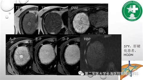 普美显mri