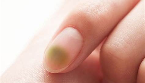 爪 ネイル カビ 恐怖！にが生えるグリーンの原因と治療法 Hachibachi