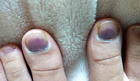 爪 ネイル 内出血 足のののお話 サロンNAIL Mishadi ミシェイディ のブログ