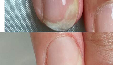 爪 ネイル 剥離 甲症 その5 2015年2月 恵比寿サロン アセトンを使わずオフ が薄くならない一層残しフィルイン 甲症経験