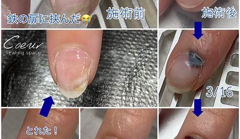 【セルフネイル】爪が黒い‼︎内出血した爪をマニキュアで隠す。 YouTube