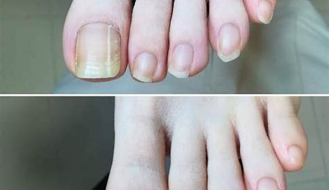 爪の白い部分が増える5つの原因と対策をわかりやすく解説します
