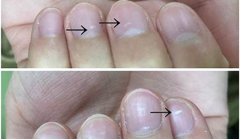 爪 白い線 手足のにができた時の考えられる原因と対処法