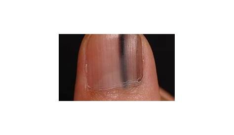 爪 長い 雑菌 甲剥離症は治るの？治療法や原因、症状について詳しく知ろう！ Hapila ハピラ