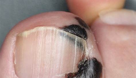 メラノーマ 足の爪が黒い 病気 画像 Hello Doctor
