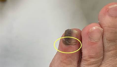足の爪が黒い 症状の原因・病気一覧・診療科 Medical DOC（メディカルドキュメント）