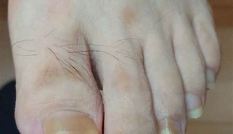 【症例写真】爪が黒い・黒くなる病気一覧・症状・治療法 [皮膚・爪・髪の病気] All About