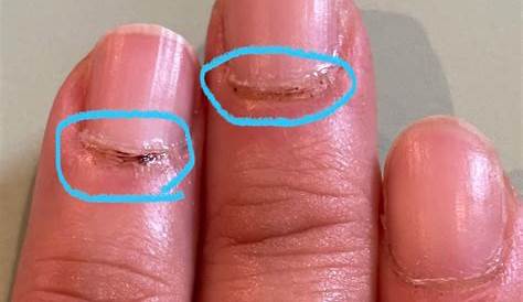 爪 黒い 点々 小さな変化に気をつけて｜の甘皮部分の点が示す病気の可能性