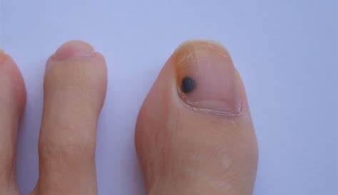 爪 黒い 知恵袋 が真っ黒に！3つの病状の見分けと原因を徹底解説。下血腫と黒色線条とメラノーマ