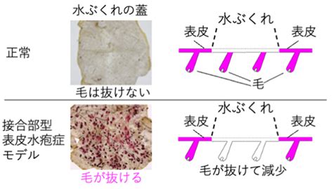 掌蹠膿疱症とは 掌蹠膿疱症コミュニティのサイト