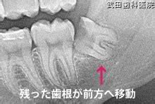 三鷹で親知らずの抜歯（智歯2回法について）を行うハートフル総合歯科グループ