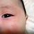 赤ちゃん 目 の 周り 赤い 斑点