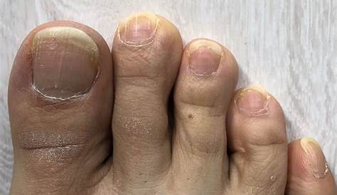 足 指 爪 白い 写真付き！のの変形や変色の理由って？巻き 、甲鉤彎症、白癬…症状と原因、治療、予防法 1 1 介護ポストセブン