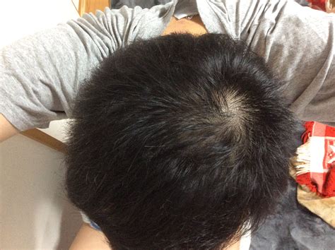 [B!] 髪の毛を太くする方法① スクワット運動編 筋トレ1日から成長ホルモン効果で髪太く ローソン薄毛抜毛AGA治療対策改善支援研究レポート