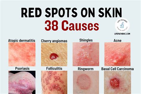    Decoding Post-Fever Red Spots: 9 Causes You Can't Ignore