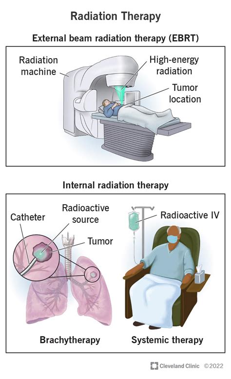    Radiation Therapy Demystified: Understanding Goals, Procedures, and What to Expect