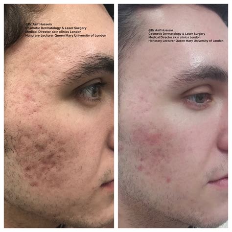 Removing Acne Scars