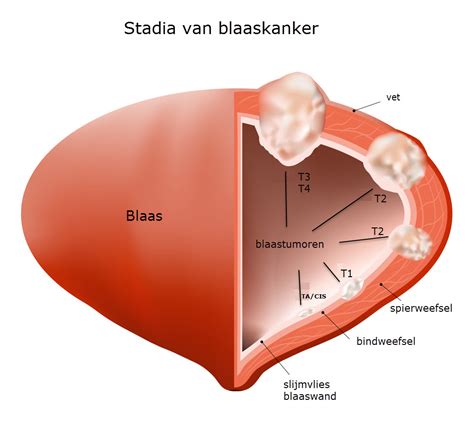 Blaaskanker