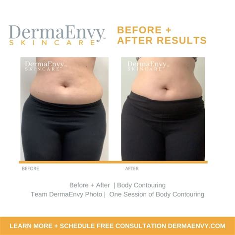 Body Contouring results