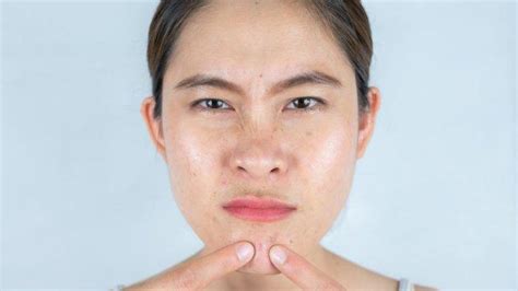 Produksi Sebum Berlebih