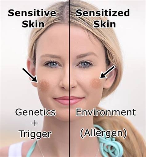 Skin Sensitivity