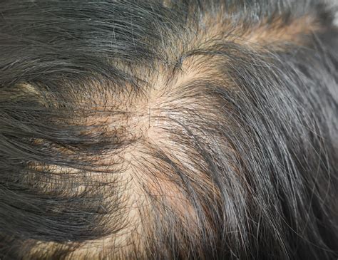 Diffuse Thinning
