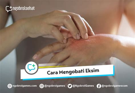 Mengobati eksim