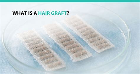 The 1 Hair Graft Means For Hair Ideas