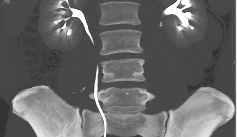Tamsulosin for the management of distal ureteral stones in