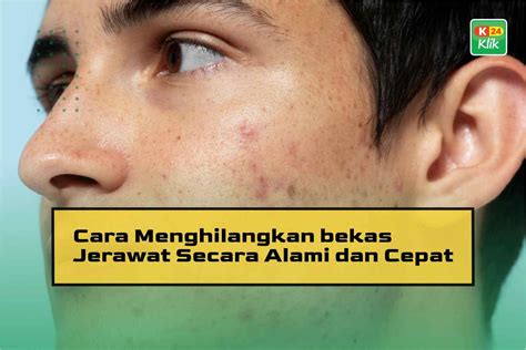 10 Cara Menghilangkan Bekas Cacar Dengan Alami Cepat Dan Mudah