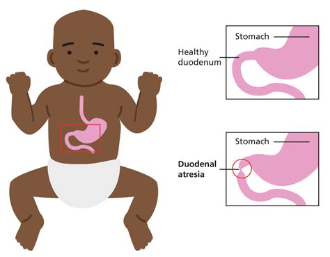 11 Decoding Duodenal Atresia: Newborn Intestinal Blockage & Prognosis.